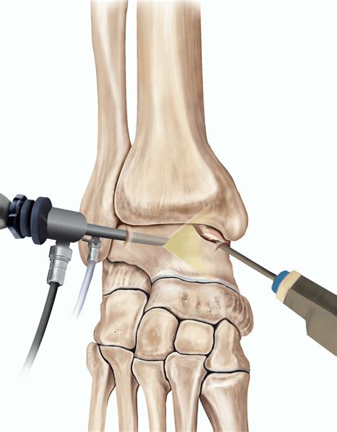foot and ankle arthroscopy foot and ankle arthroscopy PDF
